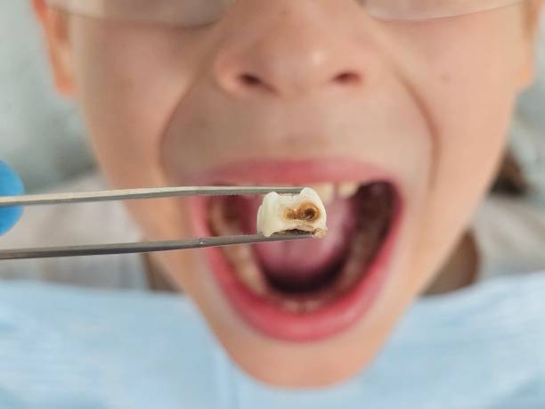 Best Broken or Chipped Tooth Repair in Coushatta, LA